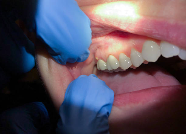 Best Teeth Whitening  in Strathmore, CA