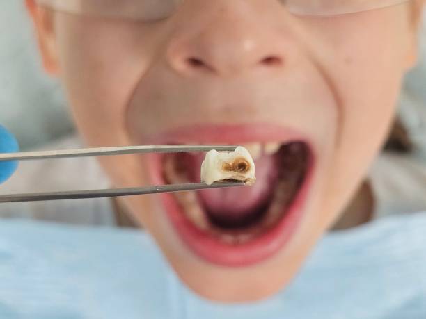 Best Chipped Tooth Repair Near Me  in Strathmore, CA